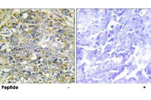 Immunohistochemistry analysis of paraffin-embedded human lung carcinoma tissue using UBXN11 polyclonal antibody . (UBXN11 anticorps)