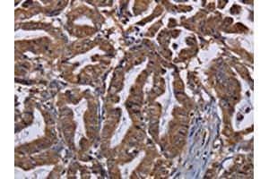 The image on the left is immunohistochemistry of paraffin-embedded Human esophagus cancer tissue using ABIN7130206(MCTS1 Antibody) at dilution 1/30, on the right is treated with fusion protein. (MCTS1 anticorps)