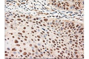 Immunohistochemical staining of paraffin-embedded Adenocarcinoma of breast using anti-NTF4 (ABIN2452547) mouse monoclonal antibody.