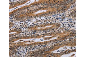 Immunohistochemistry of Human gastric cancer using NDUFAF4 Polyclonal Antibody at dilution of 1:45 (NDUFAF4 anticorps)