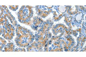 Immunohistochemistry of paraffin-embedded Human thyroid cancer tissue using COG1 Polyclonal Antibody at dilution 1:60