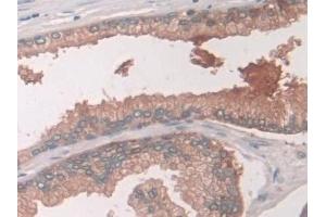 Detection of USP6NL in Human Prostate Tissue using Polyclonal Antibody to USP6 N-Terminal Like Protein (USP6NL) (USP6NL anticorps  (AA 1-292))
