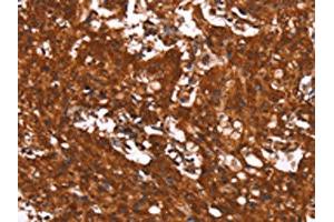 The image on the left is immunohistochemistry of paraffin-embedded Human gastic cancer tissue using ABIN7190910(HCAR2 Antibody) at dilution 1/40, on the right is treated with synthetic peptide. (HCAR2 anticorps)
