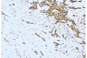 ABIN6275653 at 1/100 staining Human lung cancer tissue by IHC-P.