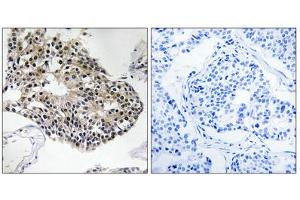 Immunohistochemistry analysis of paraffin-embedded human breast carcinoma tissue using RPS25 antibody. (RPS25 anticorps  (C-Term))