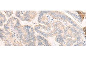 Immunohistochemistry of paraffin-embedded Human thyroid cancer tissue using COG4 Polyclonal Antibody at dilution of 1:30(x200) (COG4 anticorps)