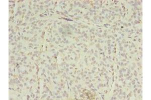 Immunohistochemistry of paraffin-embedded human breast cancer using ABIN7151851 at dilution of 1:100