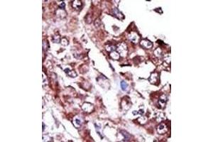 Formalin-fixed and paraffin-embedded human cancer tissue reacted with the primary antibody, which was peroxidase-conjugated to the secondary antibody, followed by AEC staining.