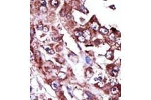 Formalin-fixed and paraffin-embedded human cancer tissue reacted with the primary antibody, which was peroxidase-conjugated to the secondary antibody, followed by AEC staining. (NME7 anticorps  (N-Term))