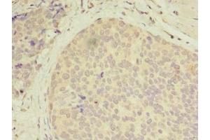 Immunohistochemistry of paraffin-embedded human gastric cancer using ABIN7146141 at dilution of 1:100