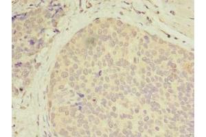 Immunohistochemistry of paraffin-embedded human gastric cancer using ABIN7146141 at dilution of 1:100 (CXCL6 anticorps  (AA 38-114))