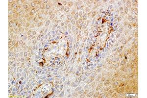 Formalin-fixed and paraffin embedded human endometrium carcinoma labeled with Rabbit Anti-Matriptase Polyclonal Antibody, Unconjugated at 1:100 followed by conjugation to the secondary antibody and DAB staining. (ST14 anticorps  (AA 11-100))