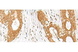 Immunohistochemistry of paraffin-embedded Human breast cancer tissue using IPO11 Polyclonal Antibody at dilution of 1:70(x200) (Importin 11 anticorps)