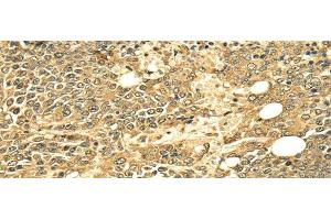 Immunohistochemistry of paraffin-embedded Human ovarian cancer using ECE2 Polyclonal Antibody at dilution of 1/25 (ECE2 anticorps)