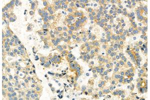 ABIN6261462 and ABIN6269075 at 1/100 staining Human lung cancer by IHC-P. (EGFR anticorps  (C-Term))