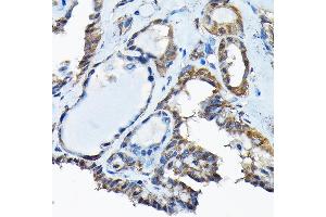 Immunohistochemistry of paraffin-embedded human thyroid cancer using RBBP9 Rabbit pAb (ABIN6129095, ABIN6146752, ABIN6146753 and ABIN6220638) at dilution of 1:200 (40x lens). (RBBP9 anticorps  (AA 1-186))