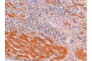 Detection of β-catenin in Human Liver cancer Tissue using Monoclonal Antibody to Beta Catenin (β-catenin)