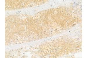 ABIN7093228 and ABIN7097240 at 1/100 staining human prostate carcinoma by IHC-P. (Insulin Receptor anticorps  (pTyr1355))
