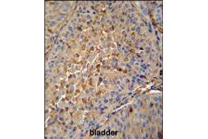 MAPRE1 antibody immunohistochemistry analysis in formalin fixed and paraffin embedded human bladder carcinoma followed by peroxidase conjugation of the secondary antibody and DAB staining. (MAPRE1 anticorps  (N-Term))