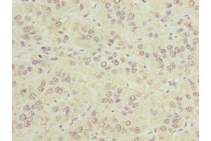 Immunohistochemistry of paraffin-embedded human liver cancer using ABIN7147940 at dilution of 1:100 (CIPC/KIAA1737 anticorps  (AA 1-399))