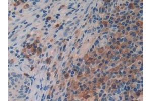 Detection of PRSS2 in Human Skin cancer Tissue using Polyclonal Antibody to Protease, Serine 2 (PRSS2)