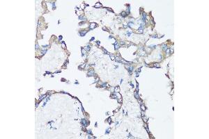 Immunohistochemistry of paraffin-embedded human lung cancer using Src antibody (ABIN6132240, ABIN6148428, ABIN6148429 and ABIN6215399) at dilution of 1:100 (40x lens). (Src anticorps  (AA 1-80))