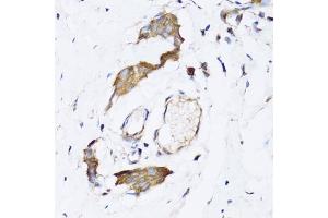 Immunohistochemistry of paraffin-embedded human breast cancer using N antibody (ABIN6129932, ABIN6144318, ABIN6144319 and ABIN6222781) at dilution of 1:100 (40x lens).