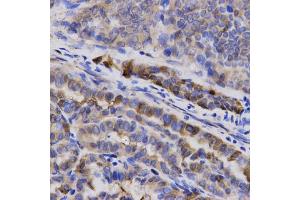 Immunohistochemistry of paraffin-embedded human thyroid cancer using SNCG antibody (ABIN5971355) at dilution of 1/200 (40x lens). (SNCG anticorps)