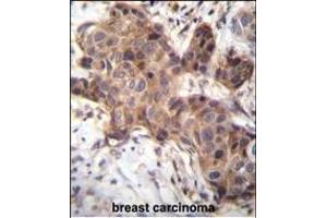 GDF9 Antibody (N-term) (ABIN656116 and ABIN2845455) immunohistochemistry analysis in formalin fixed and paraffin embedded human breast carcinoma followed by peroxidase conjugation of the secondary antibody and DAB staining. (GDF9 anticorps  (N-Term))