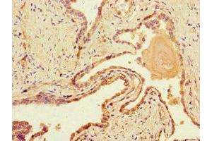 Immunohistochemistry of paraffin-embedded human prostate cancer using ABIN7150861 at dilution of 1:100 (DNAH1 anticorps  (AA 2225-2407))