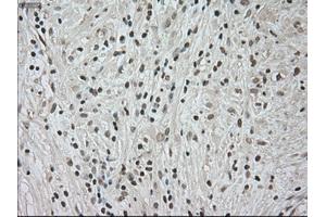 Immunohistochemical staining of paraffin-embedded Carcinoma of kidney tissue using anti-NTRK3mouse monoclonal antibody. (NTRK3 anticorps)