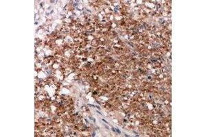 Immunohistochemical analysis of Vimentin staining in human breast cancer formalin fixed paraffin embedded tissue section. (Vimentin anticorps  (C-Term))