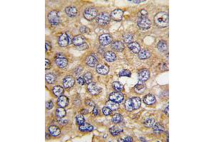 Formalin-fixed and paraffin-embedded human hepatocarcinoma tissue reacted with PFKFB4 antibody , which was peroxidase-conjugated to the secondary antibody, followed by DAB staining. (PFKFB4 anticorps  (AA 266-296))