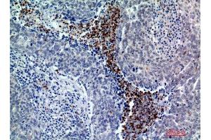 Immunohistochemistry (IHC) analysis of paraffin-embedded Human Breast Cancer, antibody was diluted at 1:200.