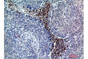 Immunohistochemistry (IHC) analysis of paraffin-embedded Human Breast Cancer, antibody was diluted at 1:200. (BATF3 anticorps)