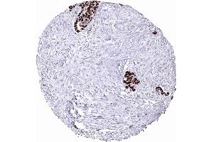 Urinary bladder Strong nuclear p53 immunostaining of all tumor cells of a muscle invasive urothelial carcinoma p53 immunohistochemistry