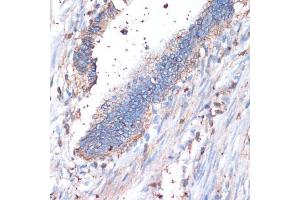 Immunohistochemistry of paraffin-embedded human colon carcinoma using CD44 antibody (ABIN3021912, ABIN3021913, ABIN3021914 and ABIN6217536) at dilution of 1:200 (40x lens). (CD44 anticorps  (AA 35-300))