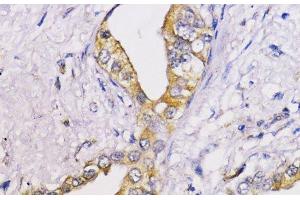 Immunohistochemistry of paraffin-embedded Human lung cancer using Bcl-2 Polyclonal Antibody at dilution of 1:100 (40x lens). (Bcl-2 anticorps)