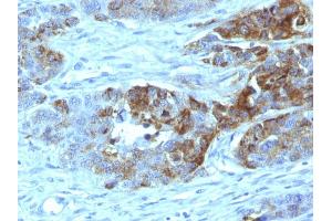 Formalin-fixed, paraffin-embedded human Colon Carcinoma stained with Blood Group Antigen H Type 2 Monoclonal Antibody (19-OLE) (ABO anticorps)