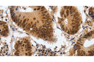 Immunohistochemistry of paraffin-embedded Human colon cancer using COPS5 Polyclonal Antibody at dilution of 1:120