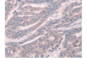 IHC-P analysis of Human Liver Cancer Tissue, with DAB staining. (TPMT anticorps  (AA 26-227))
