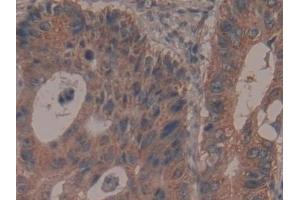 Detection of GARS in Human Colorectal cancer Tissue using Polyclonal Antibody to Glycyl tRNA Synthetase (GARS)