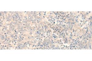 Immunohistochemistry of paraffin-embedded Human cervical cancer tissue using ERP27 Polyclonal Antibody at dilution of 1:35(x200) (ERP27 anticorps)