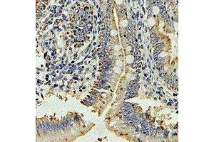 Immunohistochemical analysis of DPP3 staining in human colon cancer formalin fixed paraffin embedded tissue section. (DPP3 anticorps)