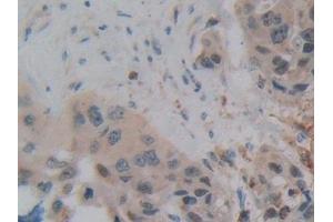 Detection of SP140 in Human Breast cancer Tissue using Polyclonal Antibody to Sp140 Nuclear Body Protein (SP140)