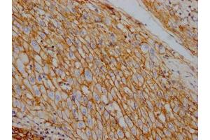 IHC image of ABIN7127819 diluted at 1:100 and staining in paraffin-embedded human liver cancer performed on a Leica BondTM system.