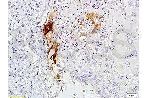 Immunohistochemistry (IHC) image for anti-Carcinoembryonic Antigen Gene Family (CEA) antibody (ABIN722931) (CEA anticorps)