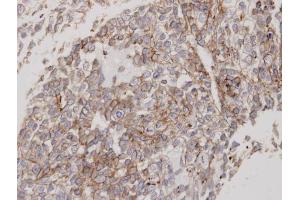 IHC-P Image Immunohistochemical analysis of paraffin-embedded human lung cancer, using Flotillin-2 , antibody at 1:100 dilution.
