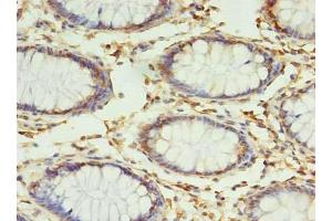 Immunohistochemistry of paraffin-embedded human colon cancer using ABIN7159947 at dilution of 1:100 (RPUSD4 anticorps  (AA 41-240))