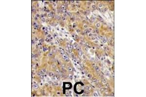 Formalin-fixed and paraffin-embedded human prostata carcinoma tissue reacted with MYO1C antibody (C-term), which was peroxidase-conjugated to the secondary antibody, followed by DAB staining. (Myosin ID anticorps  (C-Term))